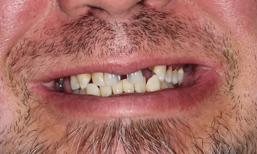 Before: broken, discolored teeth with gaps.