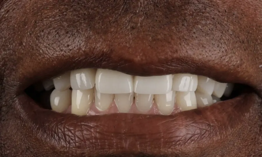 After: the same smile with the gaps closed.