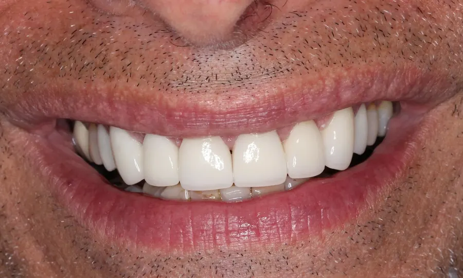 A full, even smile after a smile remake at Kerst & Caskey.