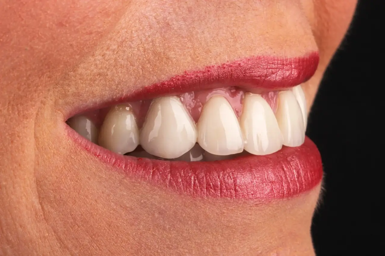 A finished smile in profile, photographed at Kerst & Caskey Family Dentistry in Shreveport.